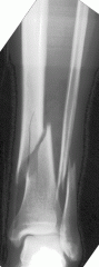 X-ray: Leg break